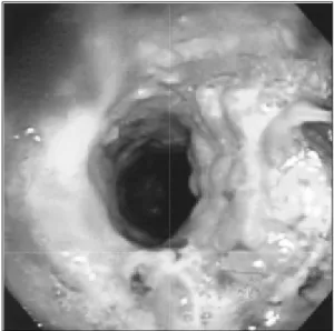 Fig. 2. Bronchoscopic image before second operation shows  tracheal stenosis and tracheal stent with granulation tissue  formation.