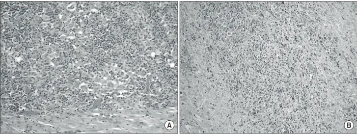 Fig. 3. Microscopic findings.  (A) shows infiltration by mononuclear cells with a nonspecific histiologic pattern (H&amp;E stain, ×100), (B) shows  positive for histiocytic cells in CD 34 immunostains (CD 34 immunostain, ×100).