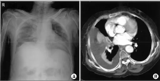 Fig. 2.  Abdominal computed tomography shows fluid collection in the retroperitoneal space of the right abdomen and dilatation of