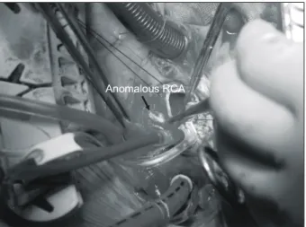Fig. 3. Operative finding shows the enlarged opening of the right coronary artery.