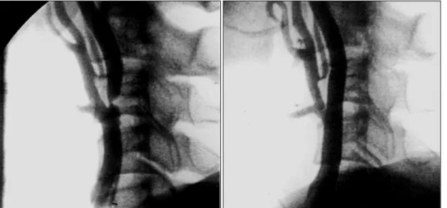 Fig. 1. A case with severe left internal carotid artery stenosis (62, male) treated with Wall stent