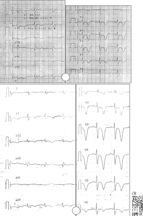 Fig. 1. The ECG showed deep and symmetrical T wave inversion in  pre-cordial leads. There was no  signifi-cant interval change on admission (A) and follow up ECG after 2  we-eks (B)