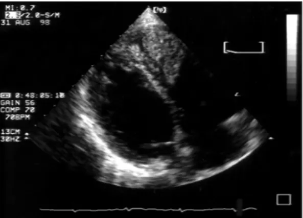 Fig. 3. Right ventriculography showed filling defect on  apex. 