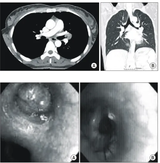 Fig. 1. Preoperative chest CT (A: 
