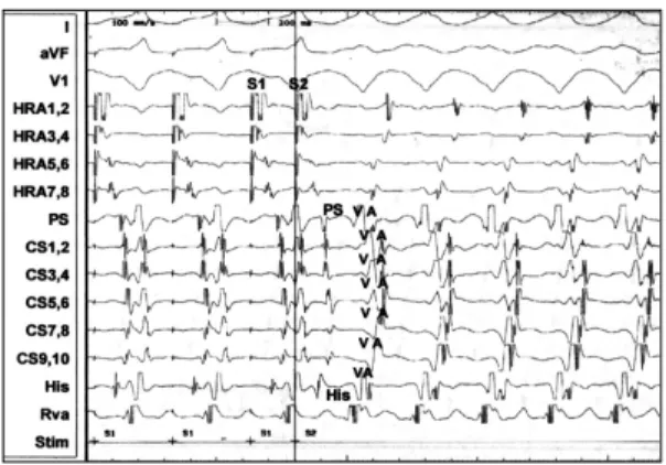 Fig. 1. Electrocardiogram on admission showed normal sinus rhythm. 