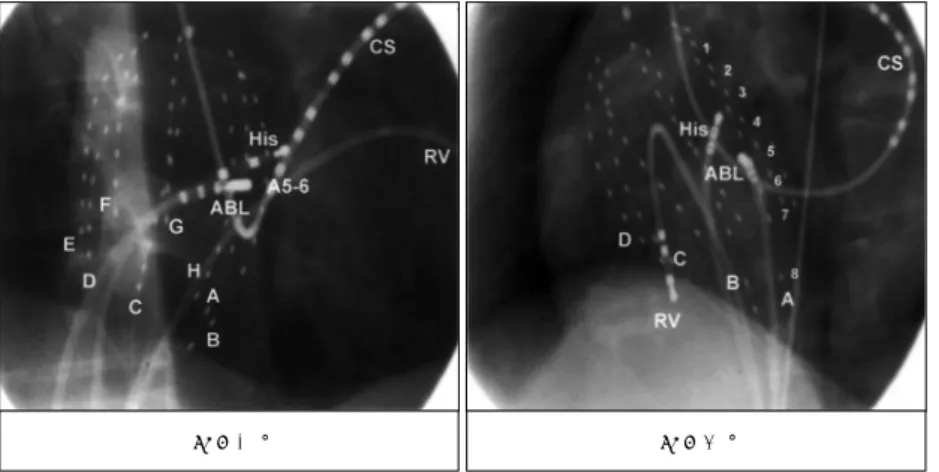Fig. 6. Multisite recordings from right atrium during on- on-going tachycardia. The earliest retrograde atrial  acti-vation was recorded at A5-6 and the distal pair of  abl-ation catheter