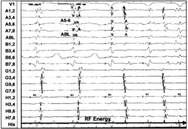 Fig. 8. Electrocardiogram after successful RF ablation was not different from that at baseline