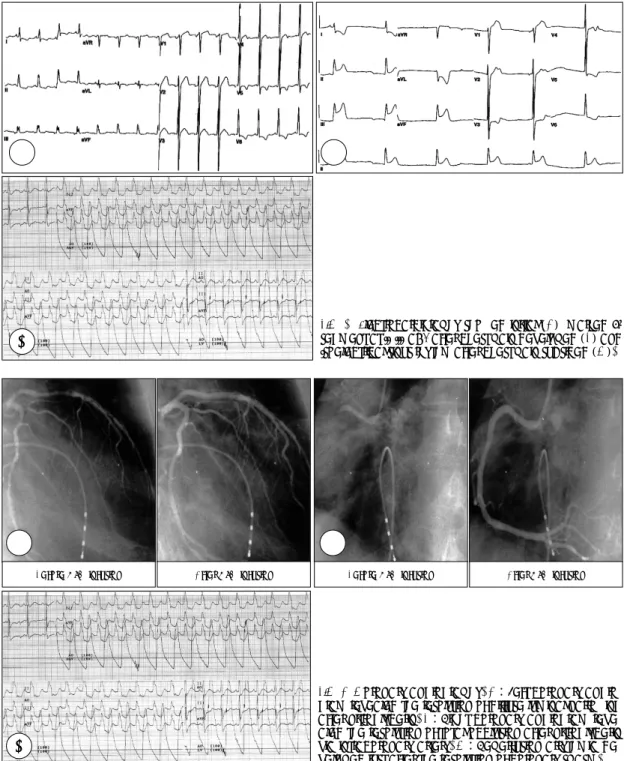 Fig. 3. Coronary angiography. A：Left coronary angio- angio-gram revealed the resolution of diffuse luminal narrowing  after nitroglycerin