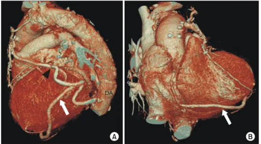Fig. 2. Reconstructed computed tomography shows diffuse and  multiple atherosclerotic plaques in descending thoracic aorta