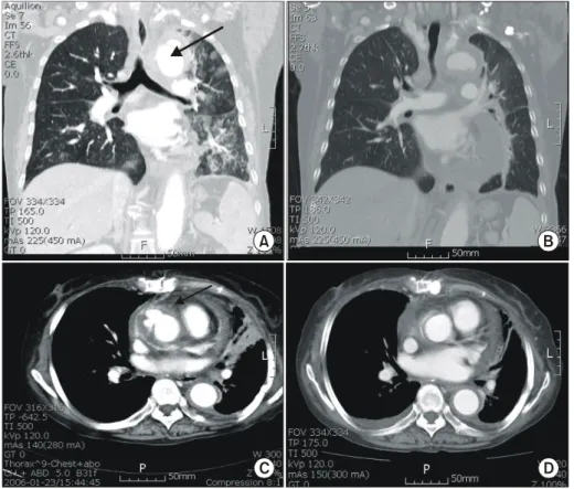 Fig. 2. The preoperative and postoper- postoper-ative CT findings of first and second re-  operation of the second case