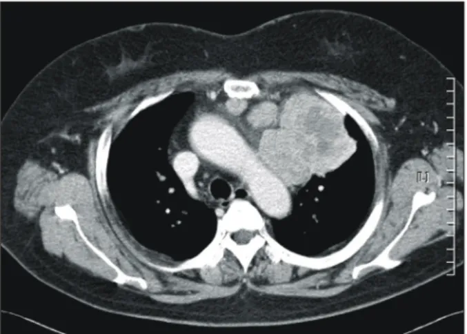Fig. 1. Chest CT reveals 10×9×5.5 cm sized solid and hetero- hetero-geneous mass with multiple lymphadenopathy