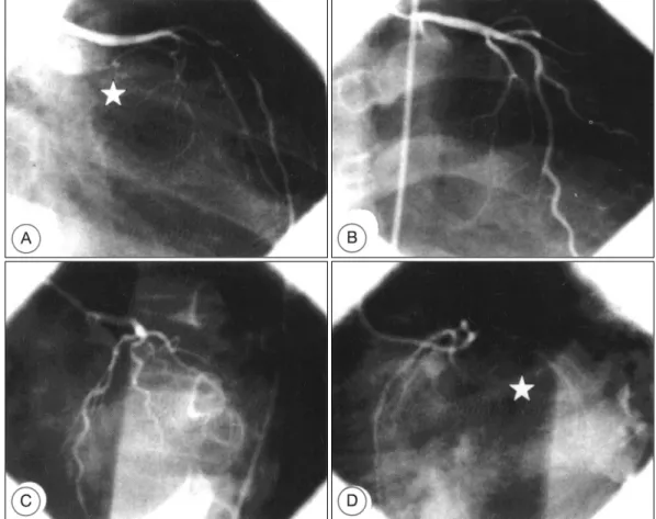 Fig. 1. Selective left coronary angiogram shows no left circumflex artery(star in A, D) originated from the left main trunk, and prominent multiple diagonal branches(C, D)