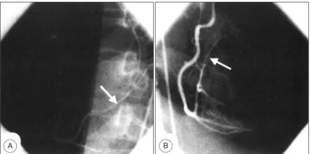 Fig. 2. Selective right coronary angiogram shows a left circumflex artery(arrow) arising as a terminal extension of right coronary artery