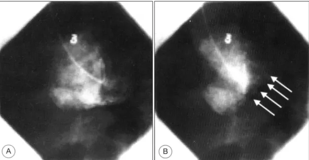 Fig. 4. Left ventriculograms showed normal wall motion in posterolateral segments (arrows), left circumflex artery territory and akinesia in apical, septal segments