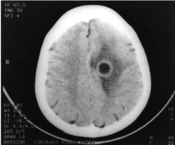 Fig. 4. Apical four-chamber view shows ventricular sep- sep-tal defect and right ventricular hypertrophy
