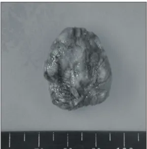 Fig. 2. Thrombus in the right atrium. Pinky brown soft tissue,  measuring 2×1×1 cm in dimensions.