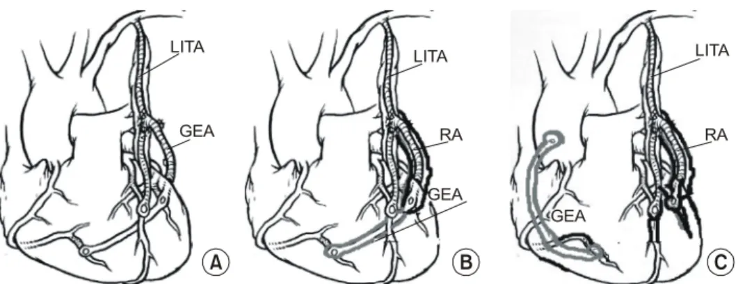 Fig. 1. Graft patterns using free skeletonized gastroepiploic arterial graft. Most cases were used a composite graft  (107, 80.4%) with left internal thoracic artery (A), and used a extended graft (22, 16.5%) to the left internal thoracic artery and radial