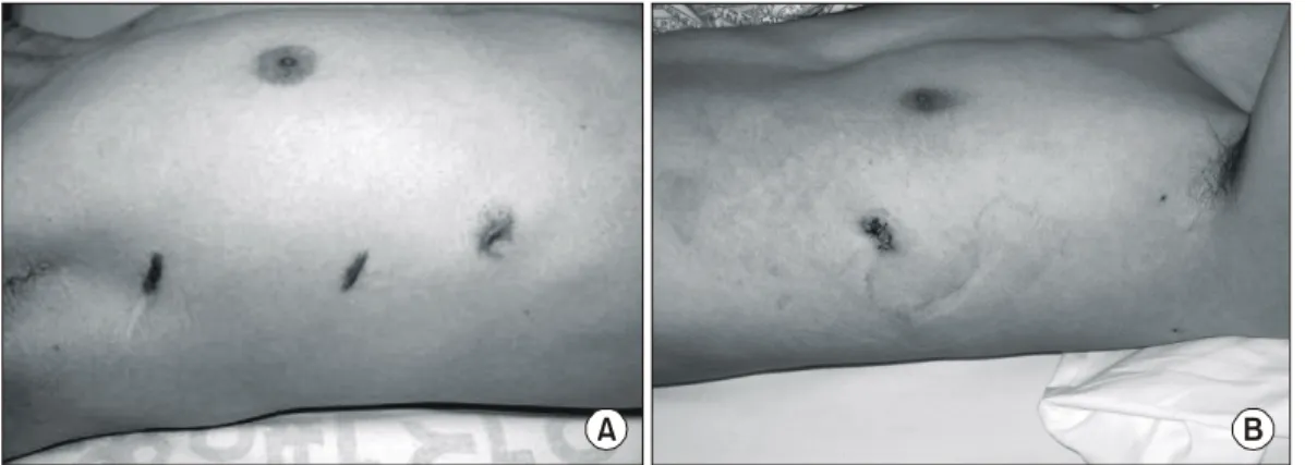 Fig. 1. The operative  wounds of 10 mm  VATS (A) and 2 mm  VATS  (B).