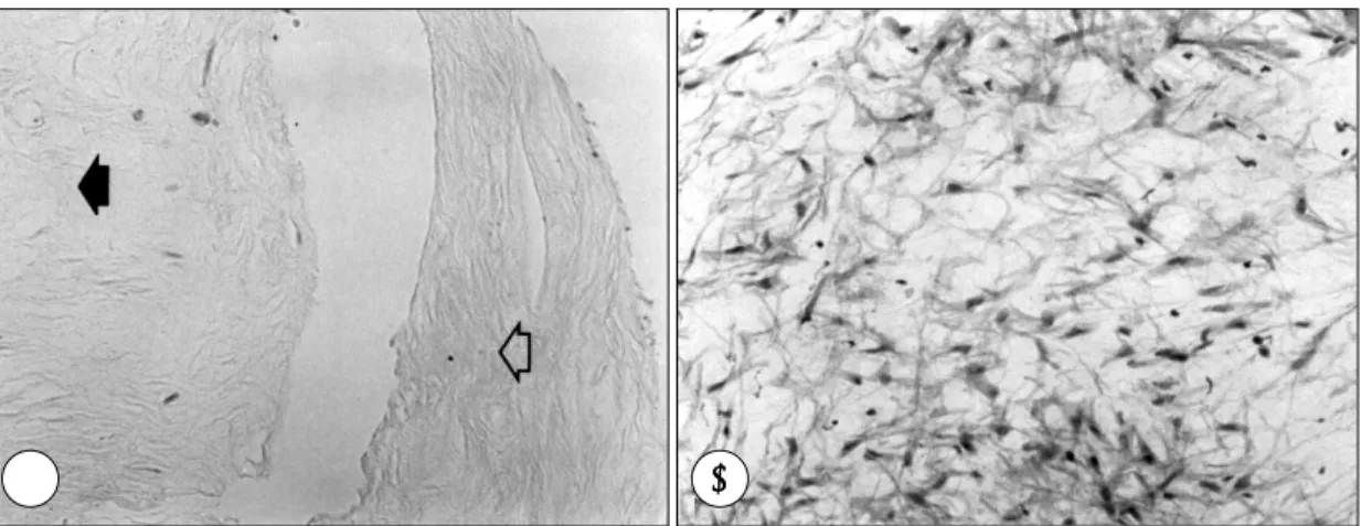 Fig. 2. Atherectomized coronary arterial in-stent restenotic specimen shows TGF-β1 labeled cells