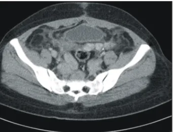 Fig. 1. Pelvic CT scan shows multiple mass in pelvic cavity,  perirectal area, bilateral iliac vein.