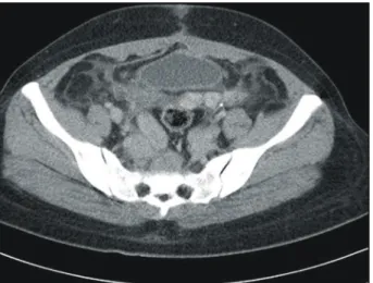 Fig. 1. Pelvic CT scan shows multiple mass in pelvic cavity,  perirectal area, bilateral iliac vein.