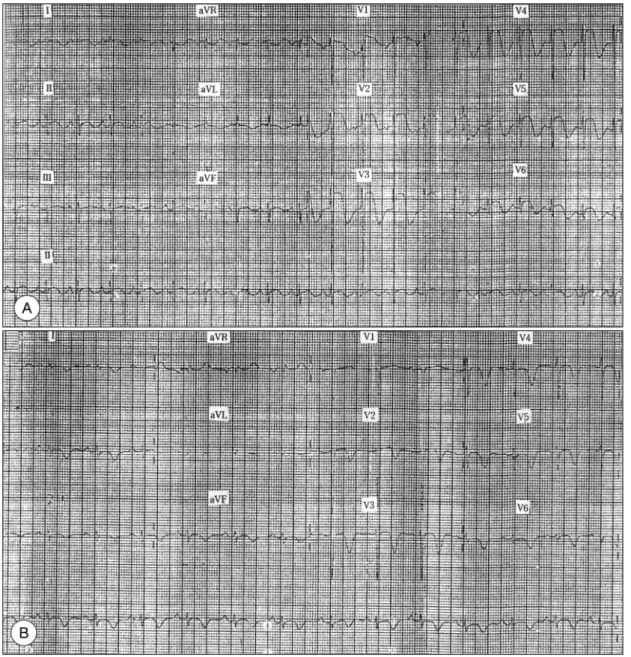 Fig. 1. Serial electrocardiograms evolution of extensive anterior wall myocardial infarction