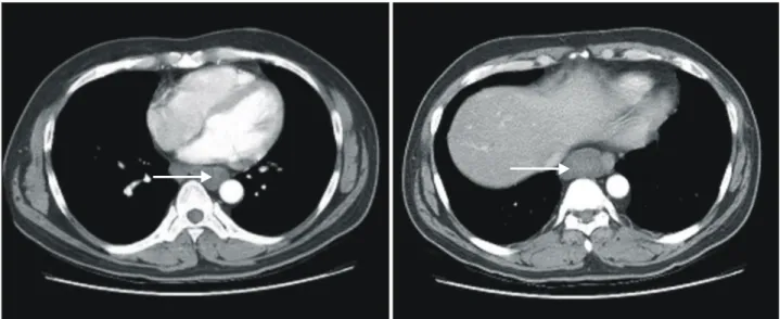 Fig. 1. Chest CT shows two suspected submucosal tumors (arrows) on both sides of the esophagus with surrounding structure indentation.