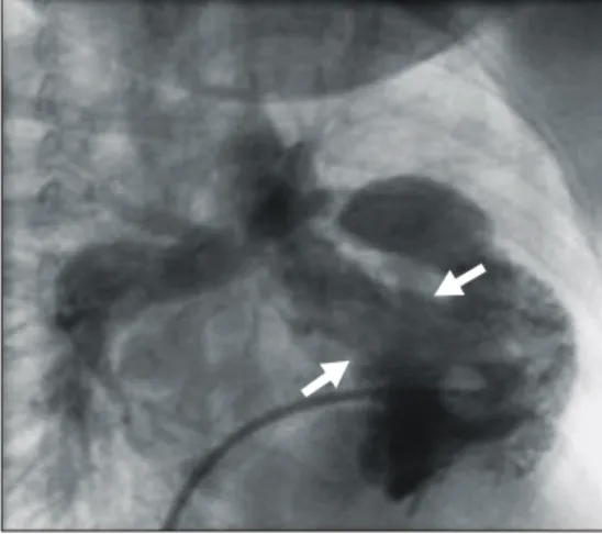 Fig. 3. Right ventriculogram shows large shunt at the level of  overriding aorta through typical large VSD (arrows).