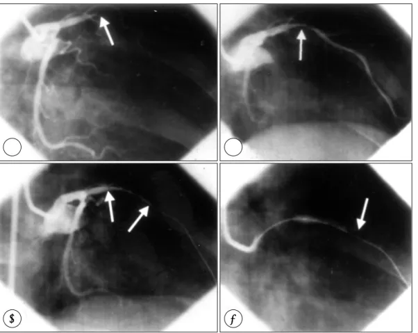 Fig. 1. A：(RAO view) Total occlusion was seen at mid-LAD, B：(RAO Cranial view) After predilation, C：(RAO Cranial view) Deploying stent, D：(RAO Cranial view) Balloon rupture during inflation of stent