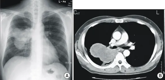 Fig. 1. (A) Chest X-ray shows  huge mid lung field mass. (B)  Chest CT shows 11×8×6 cm  sized lobulating mass on right  middle lobe.