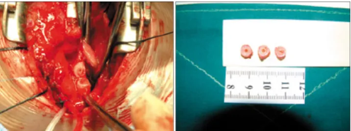 Fig. 4. Postoperative chest computer tomographic scan of  case 1. Coronal image shows widely patent distal trachea and  left main bronchus.
