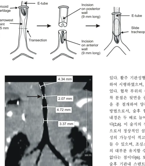 Fig. 6. Operative scheme of  case 2. The stenotic segment  is divided transversely at its  mi-dpoint, the upper stenotic  seg-ment is incised 9 mm long  ver-tically posteriorly, the lower  ste-notic segment is incised 9 mm  long anteriorly, then the two  s