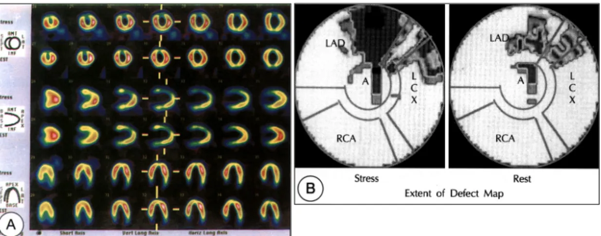 Fig. 1. Exercise and rest SPECT myocardial perfusion imaging with Tl-201. A localized uptake defect in the anterior wall on the initial stress images is present to a lesser degree on the resting images