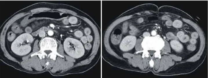 Fig. 1. CT scan shows diffuse circumferential wall thickening of the small bowel loops.