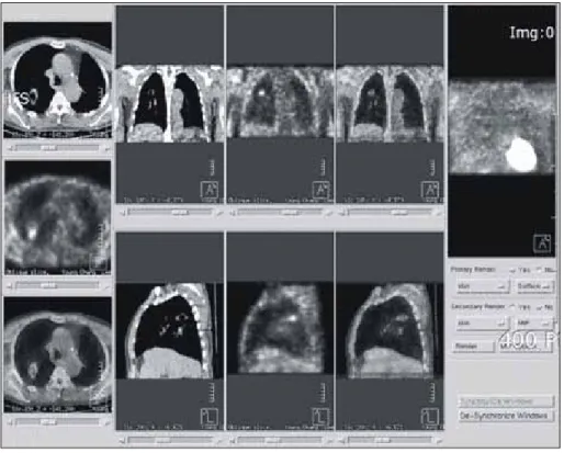 Fig. 3. Follow up PET CT. Faint meta- meta-bolic activity of the RLL mass lesion  was seen