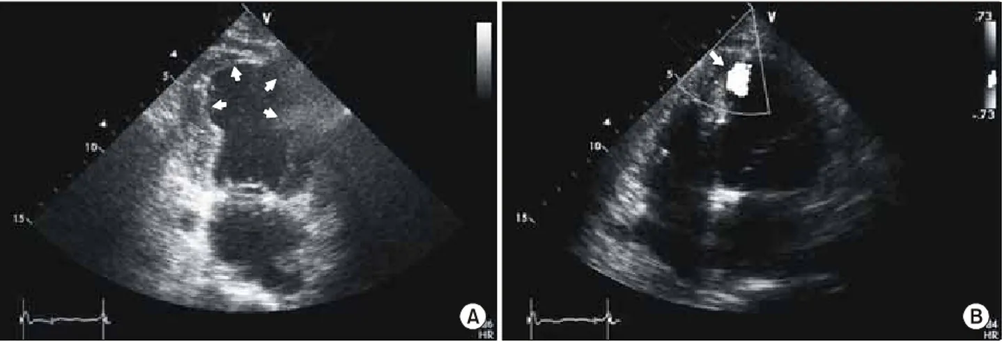 Fig. 2. Apical remnant aneurysmal space (white arrows) after bovine pericardial patch repair of postinfarction VSD (A) and minimal leakage (white arrow) after Teflon felt patch repair of postinfarction VSD (B).