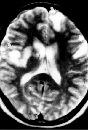 Fig. 2. Magnetic resonance imaging, T2 weight axial  image. Patchy nodular lesions of multiple high signal  intensity (arrows) in both temporal lobes and left frontal  lobe are noted