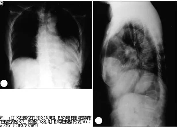 Fig. 1. Chest radiograph demonstrates a round and calcified  B 