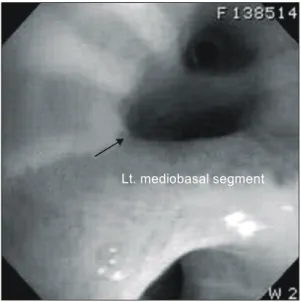 Fig. 2. Preoperative bronchoscopic finding: External compression of mediobasal segment of the left lower lobe