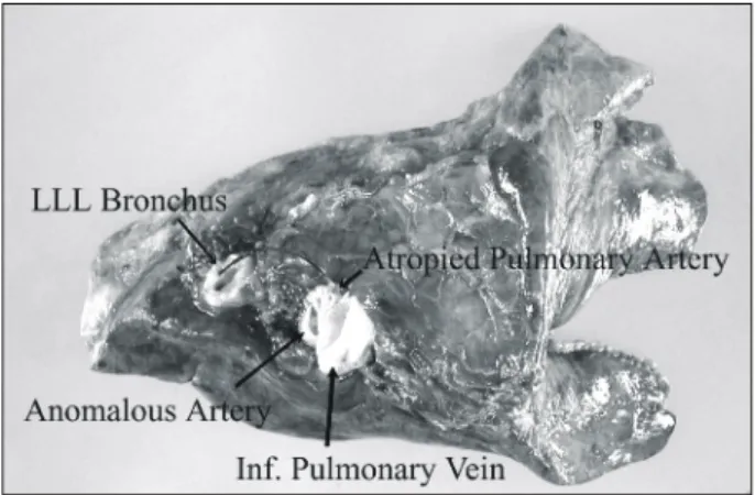 Fig. 5. Specimen of the left lower lobe.