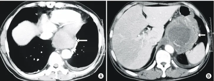 Fig. 2. The cut surface shows pale brownish to reddish ap- ap-pearance, multiple focal necrosis, and hemorrhages.