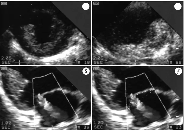 Fig. 4. Correlation between jet area of mitral regurgita- regurgita-tion(MR) and incomplete leaflet closure area(ILCA)