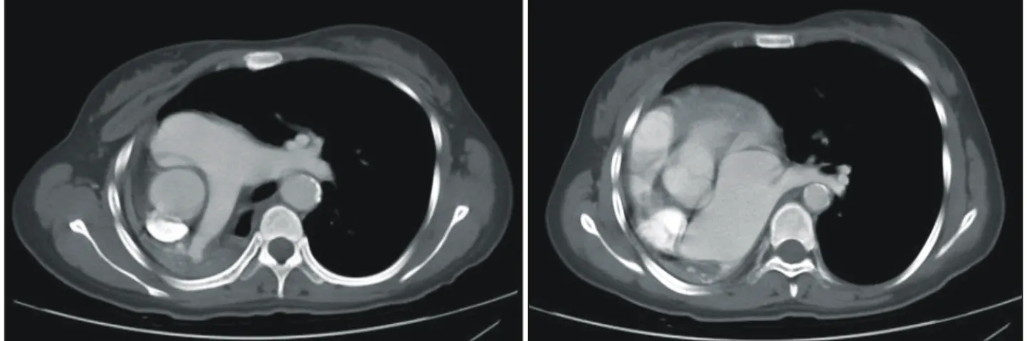 Fig. 2. Preoperative computed tomography shows mediastinal shift to the right and displacement of the heart with counterclockwise rotation.