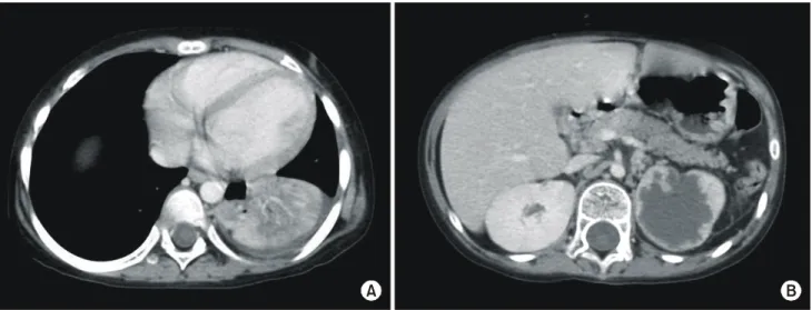 Fig. 1. Preoperative chest and abdominal images.  (A) Chest computed tomography shows pneumonic consolidation in the left lower lobe, (B) Abdominal computed tomography shows multilobulated abscess involving  upper  pole of the left kidney