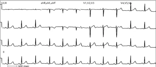 Fig. 3. Resting state 12 lead ECG on ER arrival. The QT interval was markedly prolonged(QT interval 560 msec, co- co-rected QT interval 666 msec)
