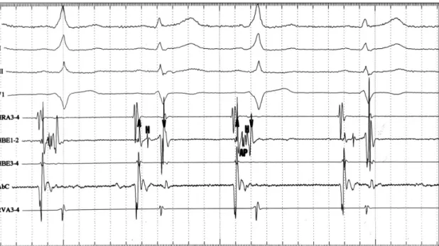 Fig. 2. Surface ECG leads and intracardiac electrograms recorded before ablation during sinus rhythm in a patient No