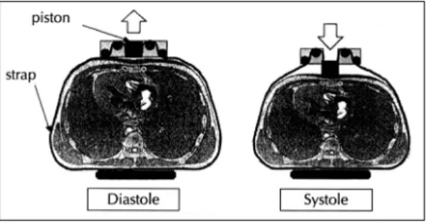 Fig. 2. Top view (upper) and side view (lower) of the  device for simultaneous sternothoracic  cardiopulmo-nary resuscitation：The device consists of two main  ele-ments