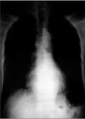 Fig. 1. Chest X-ray shows flask shaped heart shadow and multiple metalic opacities in the hepatic shadow.