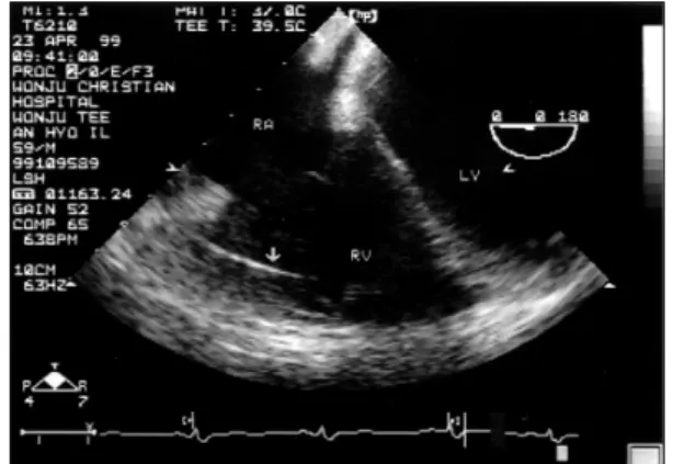 Fig. 4. Fluoroscophic image (RAO 30°) shows a vertical linear opacity in the heart shadow and multiple metalic opacities in the hepatic shadow
