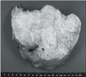 Fig. 2. This picture shows yellowish white huge mass, weighing  1,000  gm. measuring 18×18×9 cm in dimension.